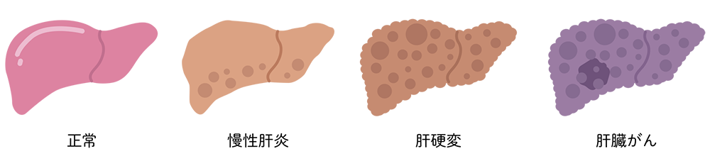 肝臓の機能が低下する「肝硬変」