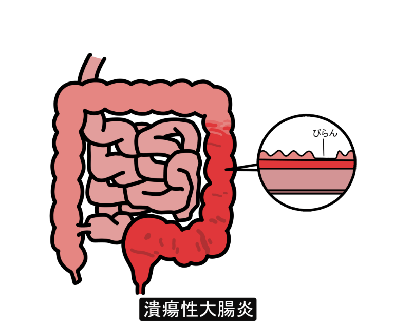 潰瘍性大腸炎とは