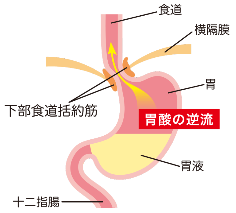 逆流性食道炎とは