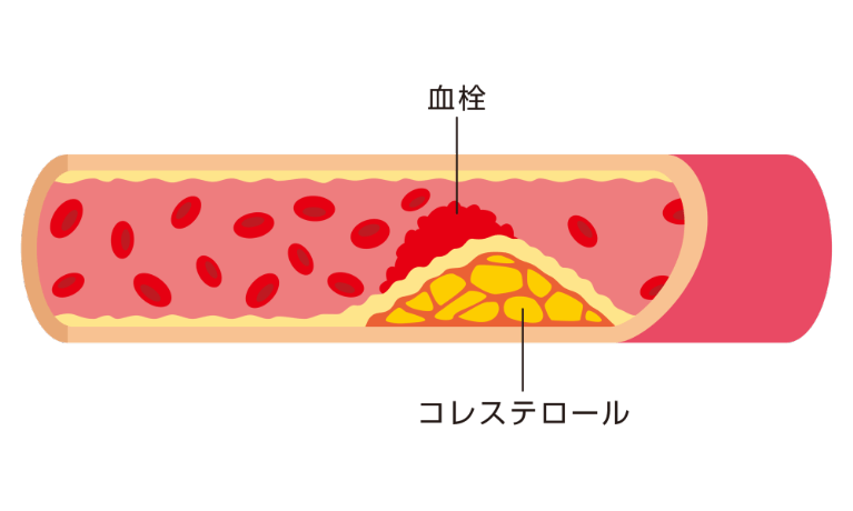 LDL（悪玉）コレステロールが高いとどうなる？