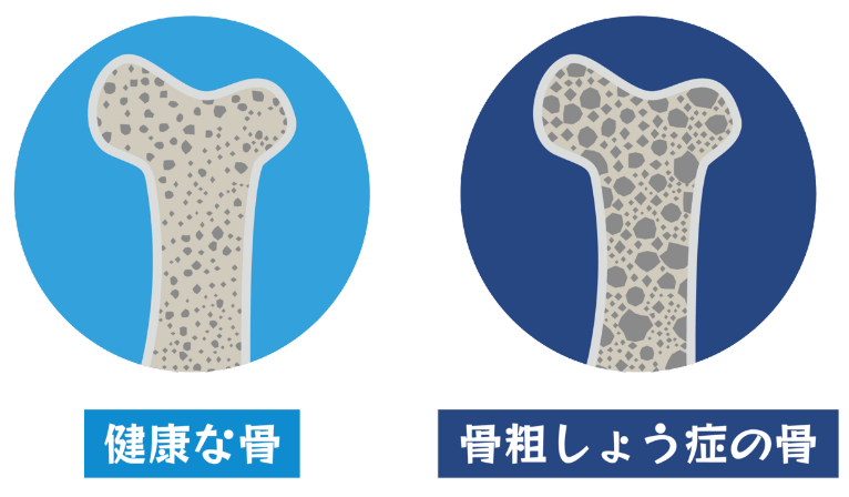 骨粗鬆症とは